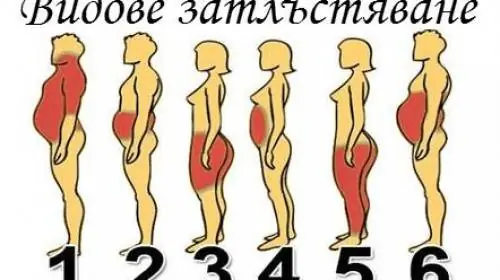 Вы задаетесь вопросом, почему не можете похудеть, ответ в 6 типах ожирения (ФОТО)