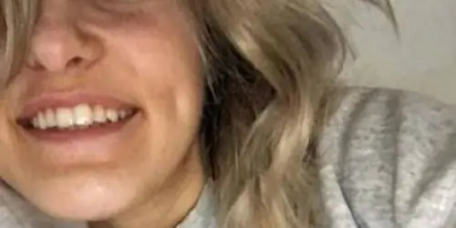 У блондинки самая странная в мире аллергия, она может умереть в любой день (ФОТО)