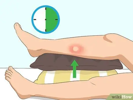Уменьшить опухание укусов насекомых Шаг 5