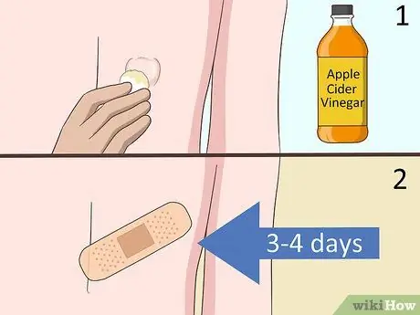 Удаление кисты на спине Шаг 13