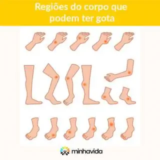 Части тела, которые могут болеть подагрой. Изображение: Минха Вида. Части тела, которые могут болеть подагрой. Изображение: Минха Вида.