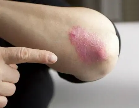 Псориаз: лечение включает использование мазей и фотодинамическую терапию