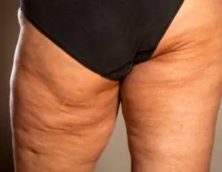 целлюлит целлюлит