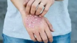 экзема