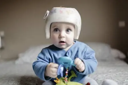плагиоцефалия