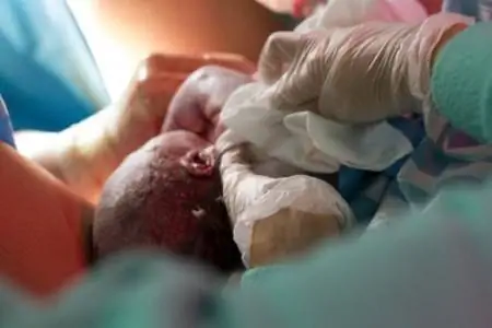 кесарево сечение кесарево сечение
