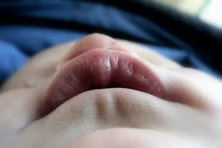 Нарушения речи: Дисглоссия