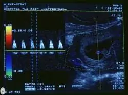 Ультразвуковая допплерография в контроле беременности
